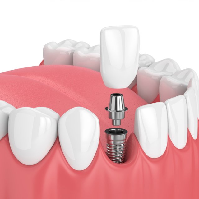 Dental-Implants