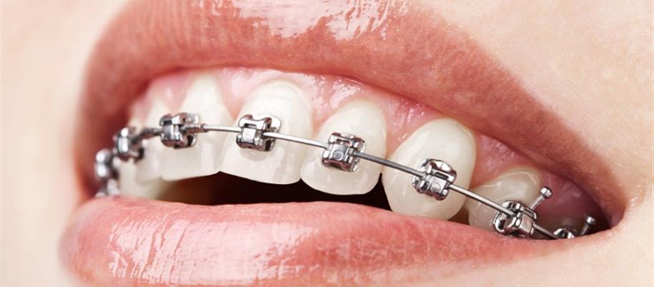 Braces service