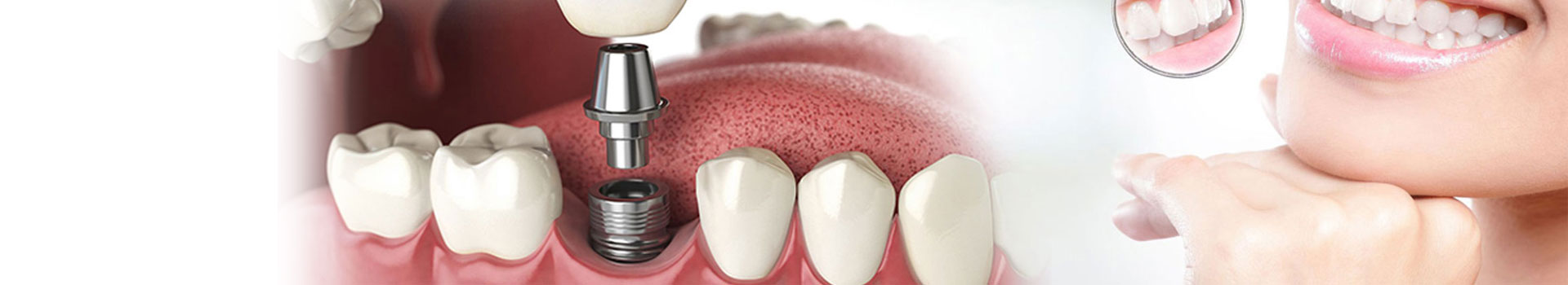 Dental Implants