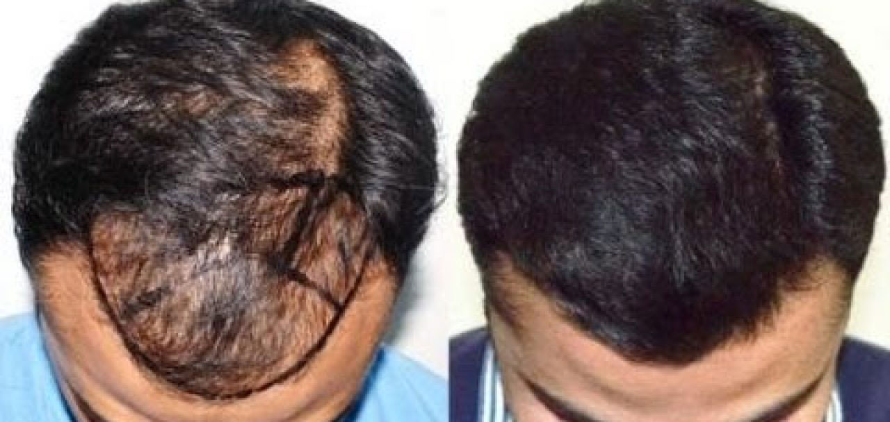 Hair Transplant