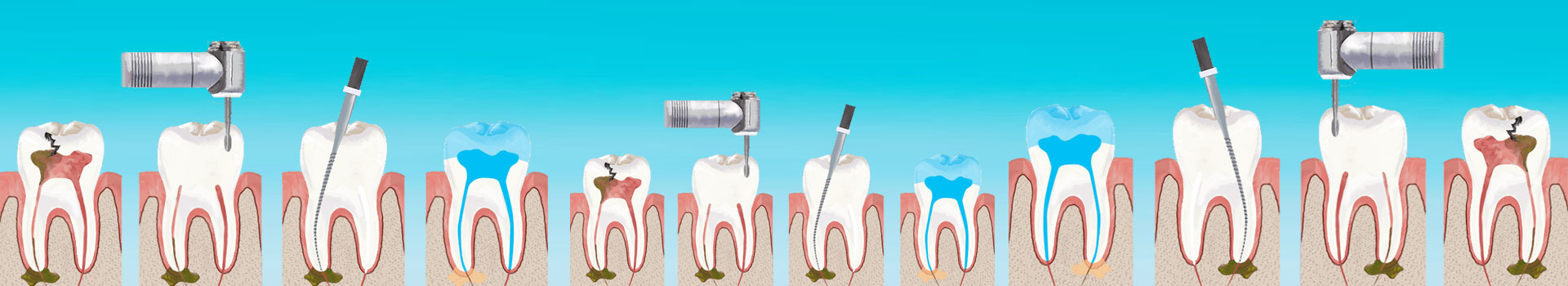 Root Canals