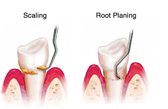 Scaling and Root Planning